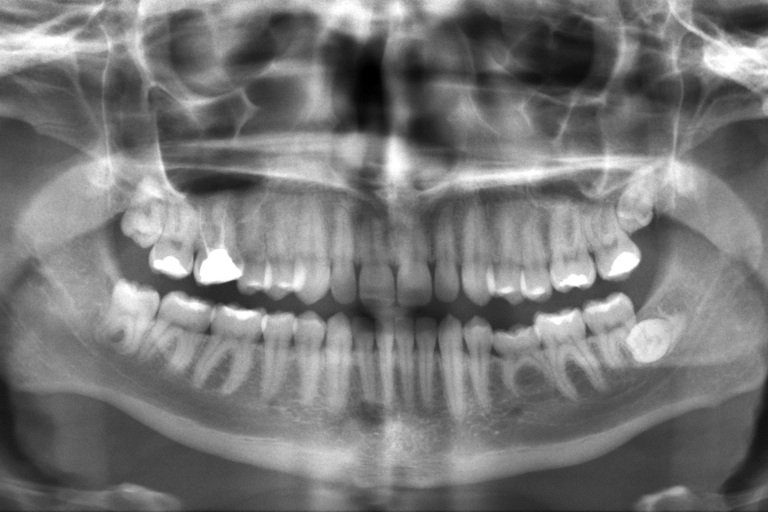 Mouth x-ray of a person's smile.
