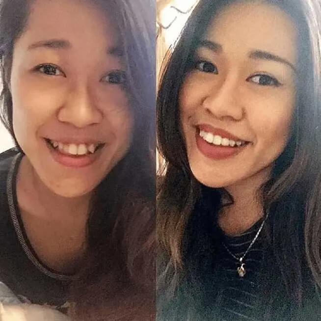 before/after Invisalign