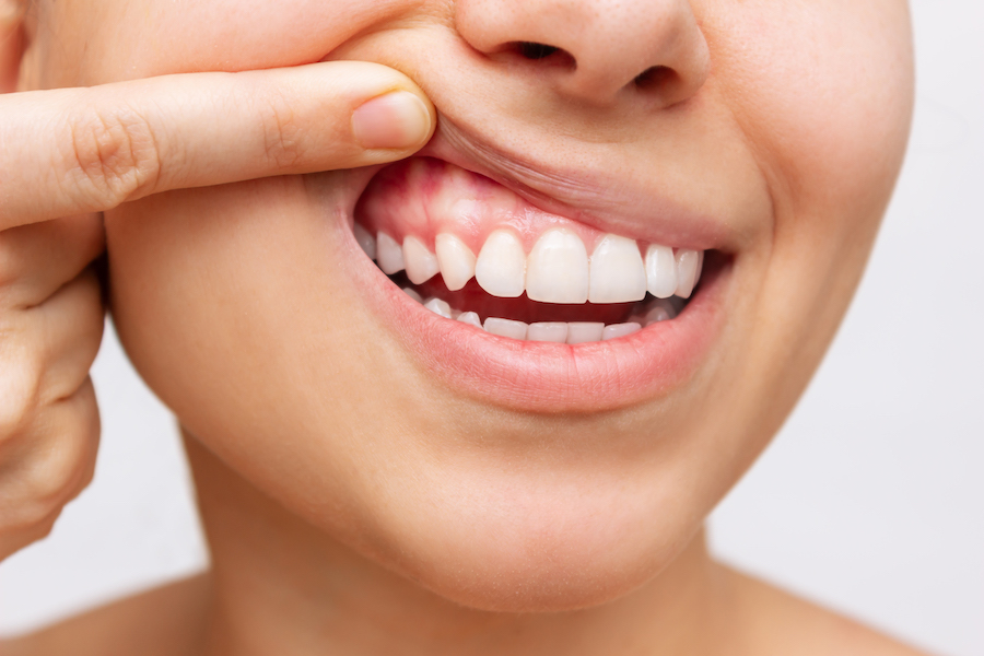 Closeup of a woman pulling up her upper lip to show her healthy gums