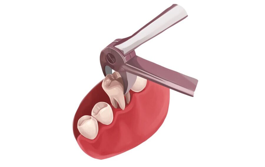 Illustration of a tooth getting extracted with a special dental tool