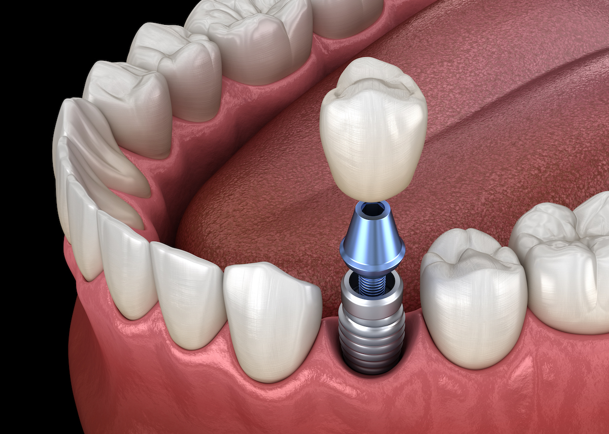 dental implant maintenance, dental implants