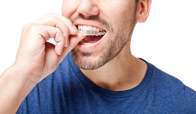 man inserting Invisalign aligner onto his teeth