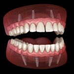 dental implants, dentures, implant-supported dentures, tooth replacement, Joplin MO, ADC Dental Group, Dr. John Durling, missing teeth