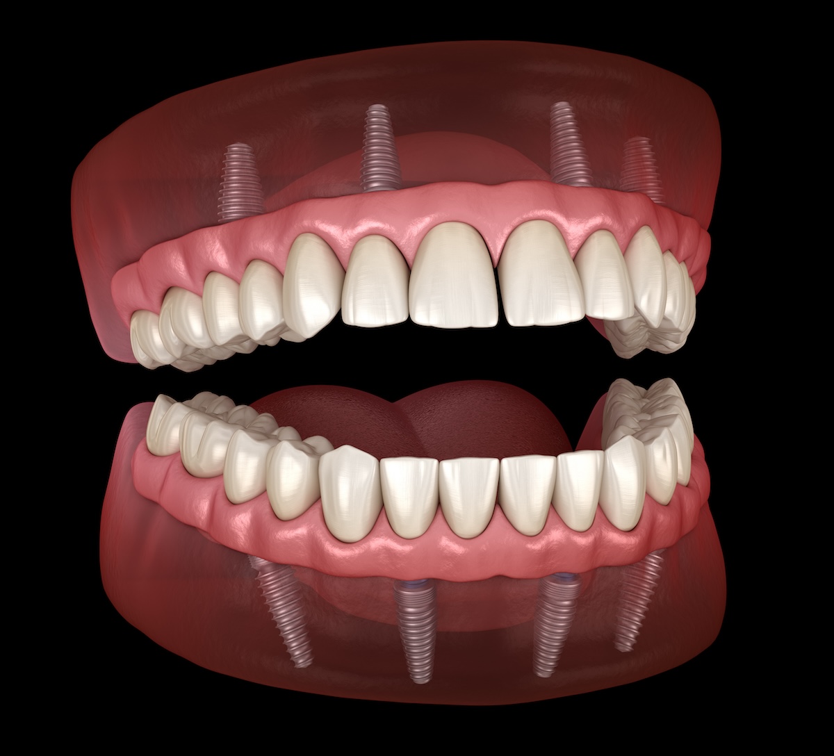 dental implants, dentures, implant-supported dentures, tooth replacement, Joplin MO, ADC Dental Group, Dr. John Durling, missing teeth