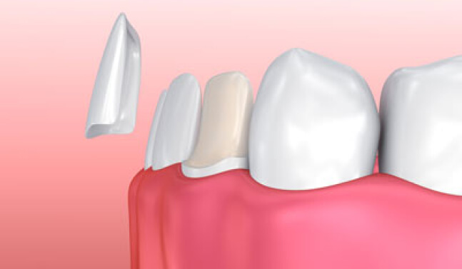 illustration of veneers