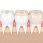 dental fillings or dental crowns