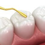 tooth colored fillings