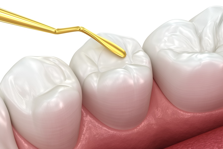 tooth colored fillings
